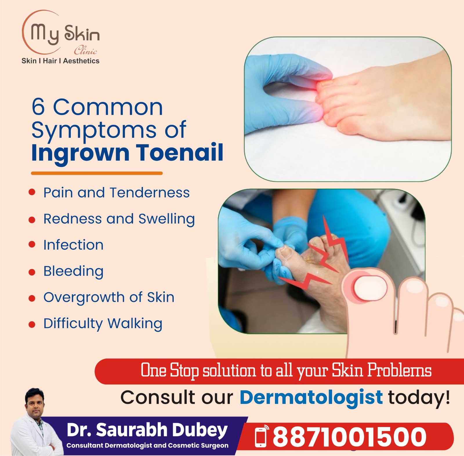 Best Ingrown Toenail Treatment Doctor in Indore